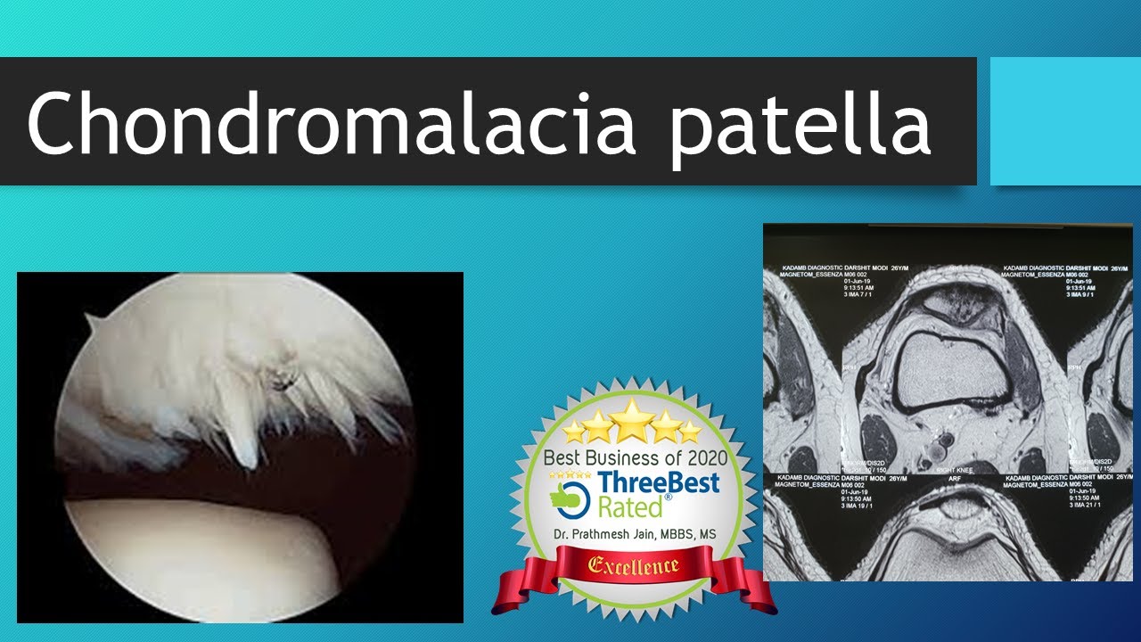 Understanding Chondromalacia Patella