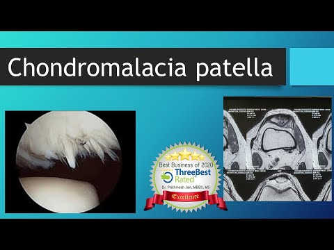 Chondromalacia patella video thumbnail